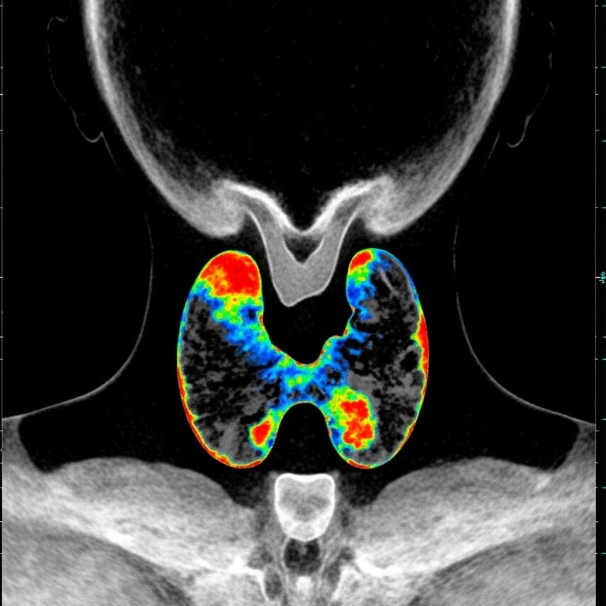اسکن تیروئید و پاراتیروئید